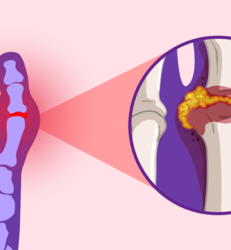 what you need to know about gout
