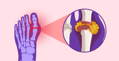 what you need to know about gout