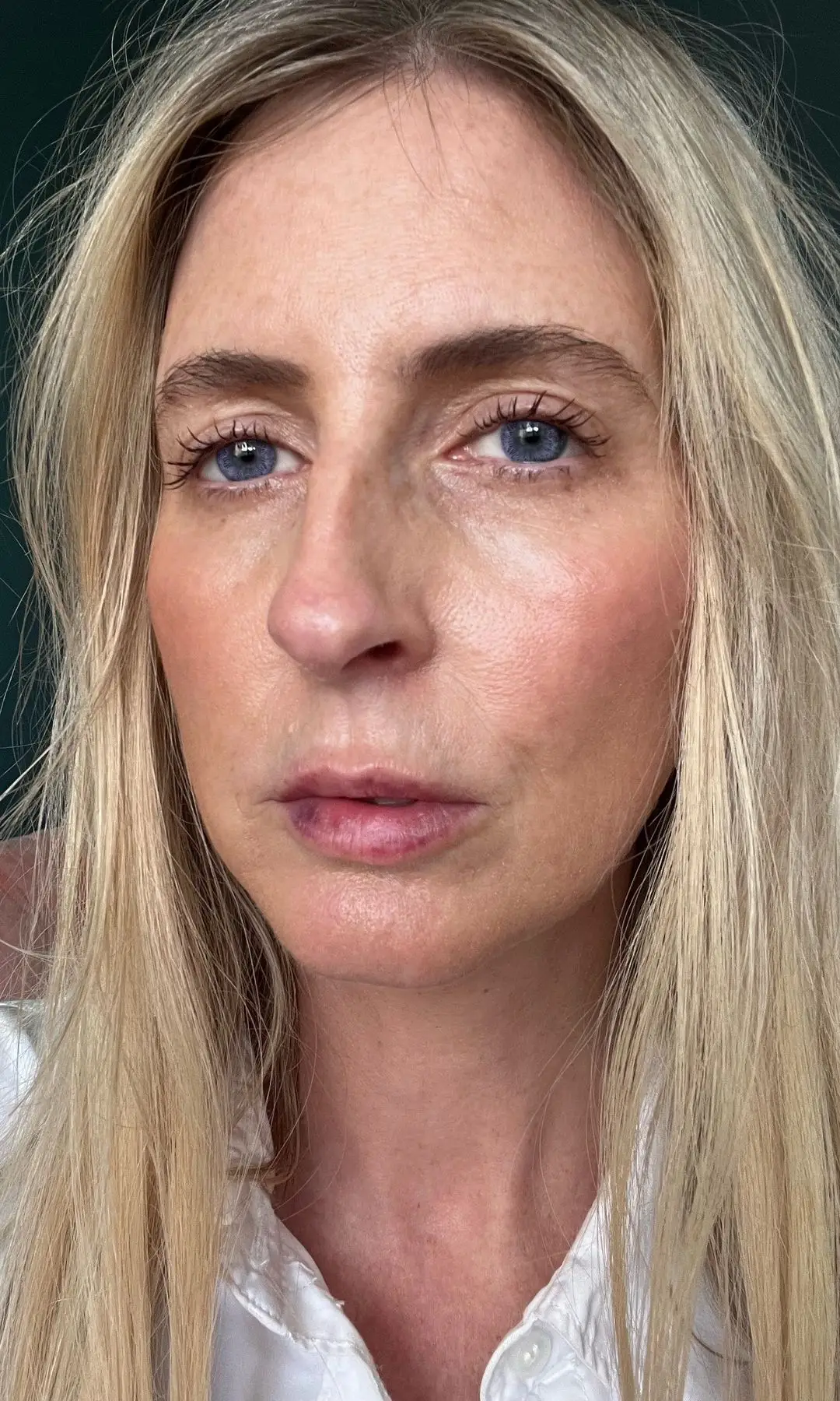 Attempting lip filler for the primary time at 48 2 Charley 12 hours after her lip filler treatment