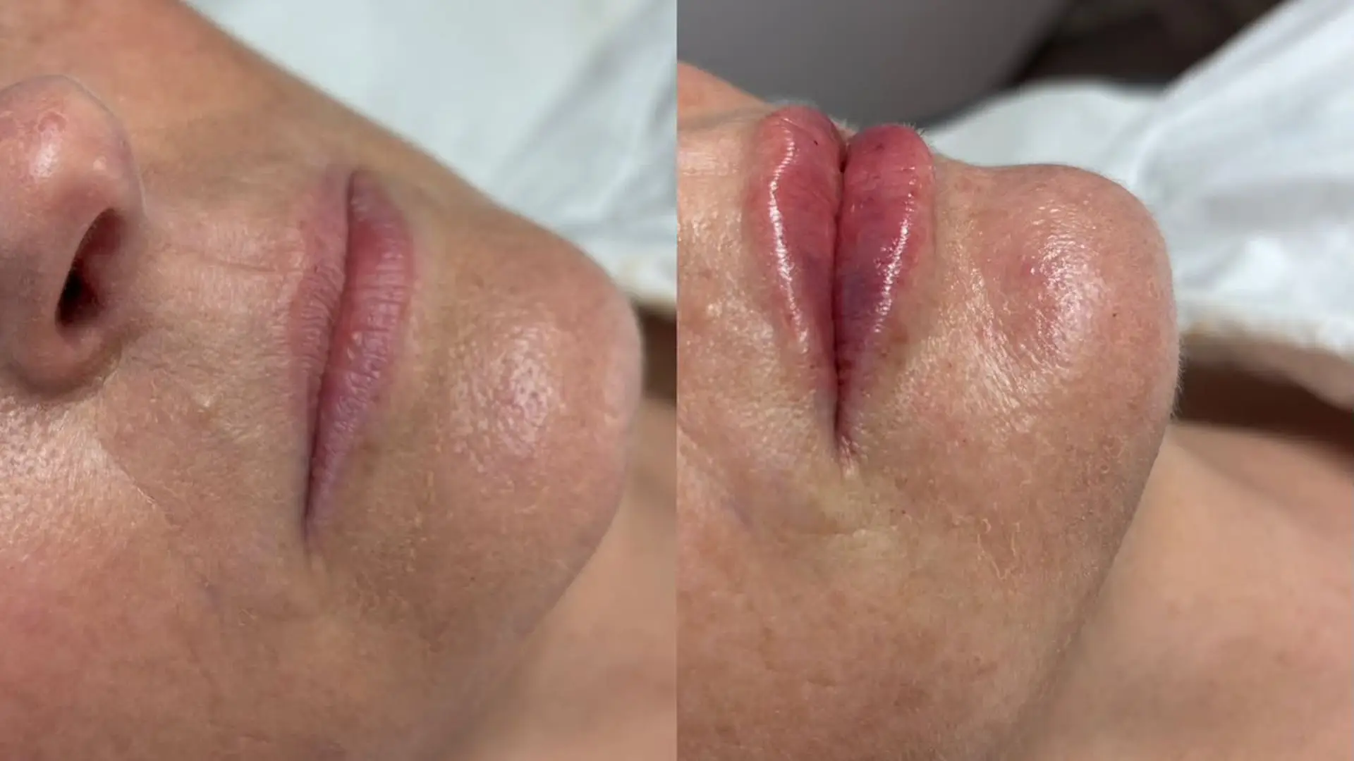 Attempting lip filler for the primary time at 48 1 Charley's lips before and immediately after